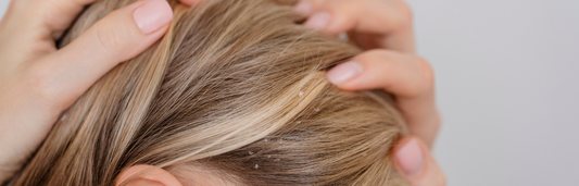 Dermatitis seborreica del cuero cabelludo: causas, síntomas y tratamientos