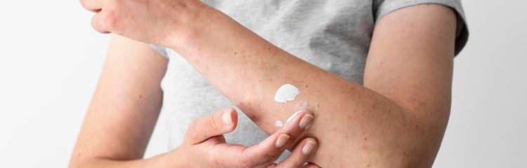 Champú Eczema Psoriasis Hongos - Alivio duradero para el cuero