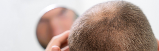 Causas de la caida del pelo y el efecto de la cistina