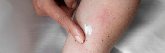 Dermatitis seborreica en la cara: qué es, causas y tratamiento