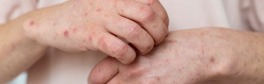 Dermatitis Atópica, ¿qué es y cómo se manifiesta?