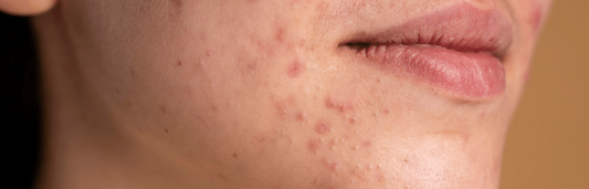 Los mejores serum para el acné: Recupera tu piel sin imperfecciones