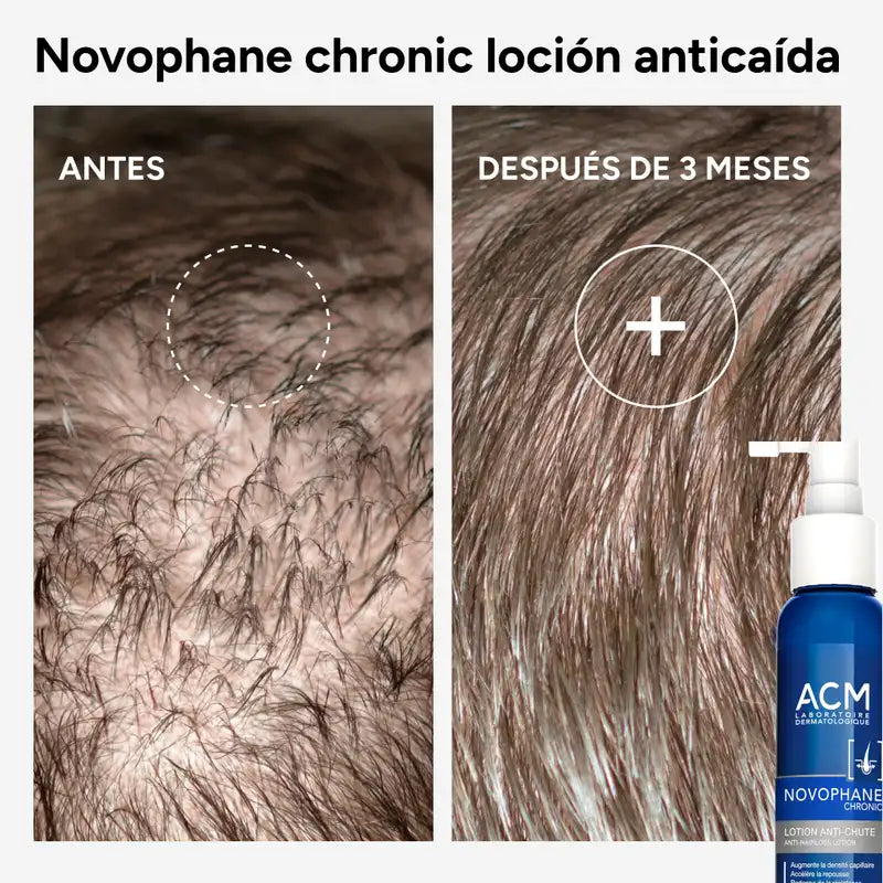 Acm Laboratoires Novophane Loción Anticaída Chronic , 100 ml