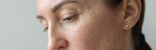 Barrera cutánea dañada: cómo recuperarla con cuidados adecuados y una rutina reparadora