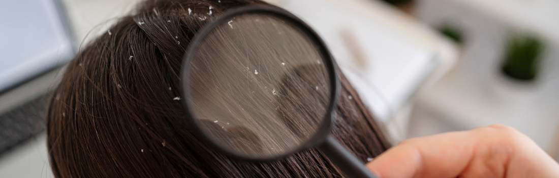 Diferencias entre caspa seca o grasa