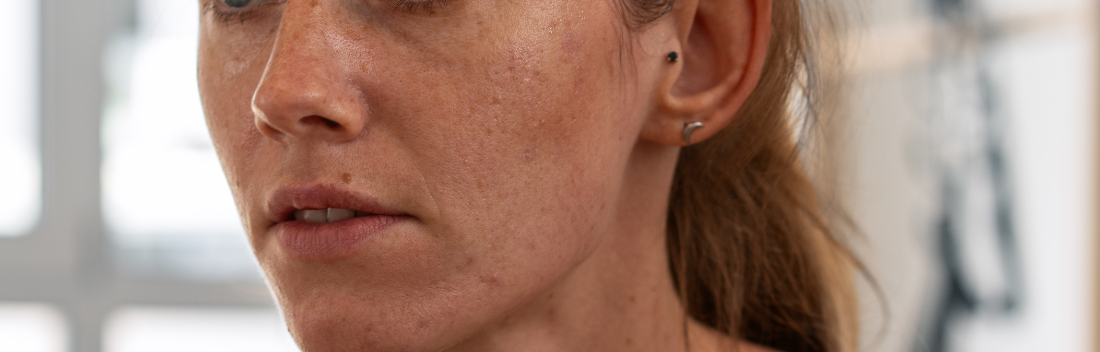 El mejor tratamiento antimanchas para despues del verano