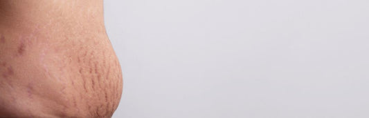 Cómo eliminar las estrías rojas