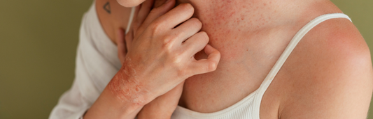 Cómo tratar la piel roja e irritada y reducir el enrojecimiento