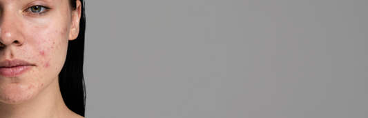 Las mejores cremas para el acné