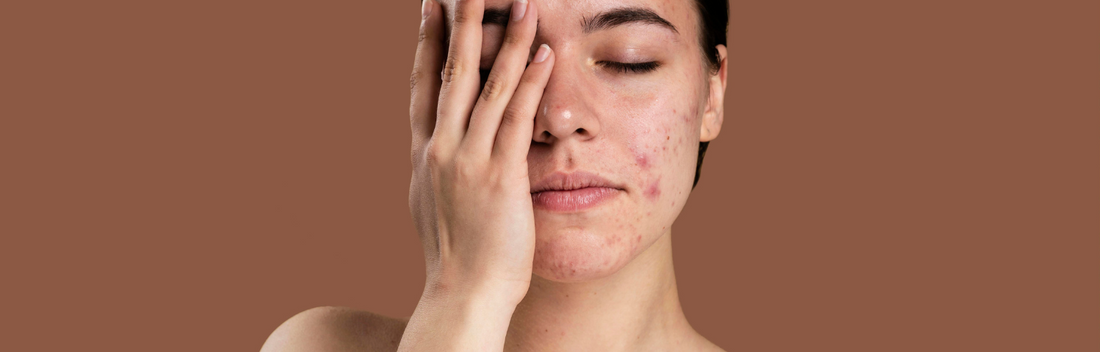 Ingredientes naturales más efectivos para combatir el acné y mejorar la salud de la piel