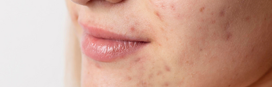 Marcas de acné ¿Cómo eliminarlas?