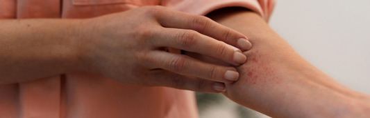 Cómo curar eczemas en la piel: consejos y productos