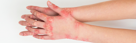 Como curar los sabañones