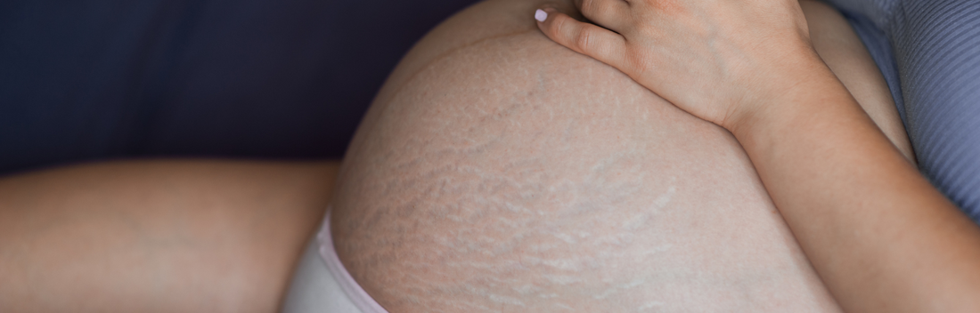 Los mejores productos para las estrías en el embarazo