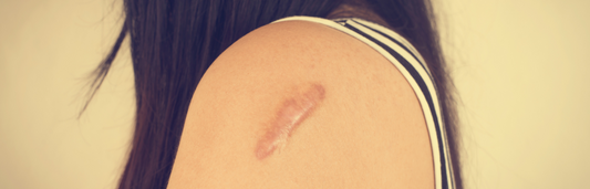 Sol y cicatrices ¿Cómo protejo mi piel?