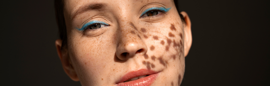 Manchas faciales ¿Cuál es su causa?