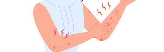 ¿Cómo cuidar la piel atópica?