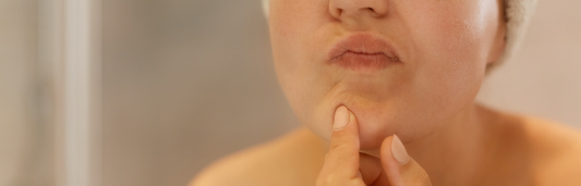 Di adiós al acné adulto en 5 pasos