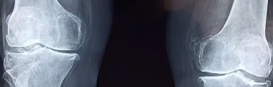 Por qué nos duelen las articulaciones y cómo combatirlo