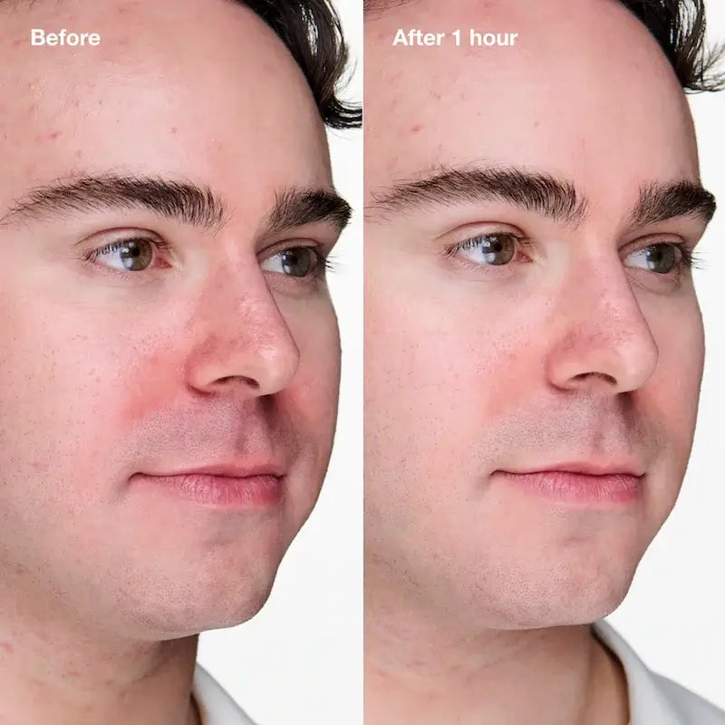 Clinique Anti-Blemish Solutions Clinical Gel De Limpieza Avanzado, 20 ml