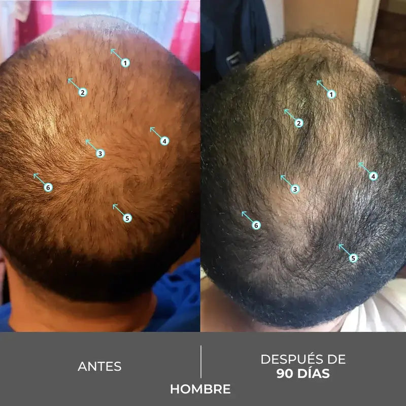 Ds Laboratories Revita Champú Anticaída Estimulante Densidad Capilar, 205 ml