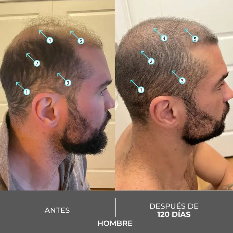 Ds Laboratories Revita Champú Anticaída Estimulante Densidad Capilar, 205 ml