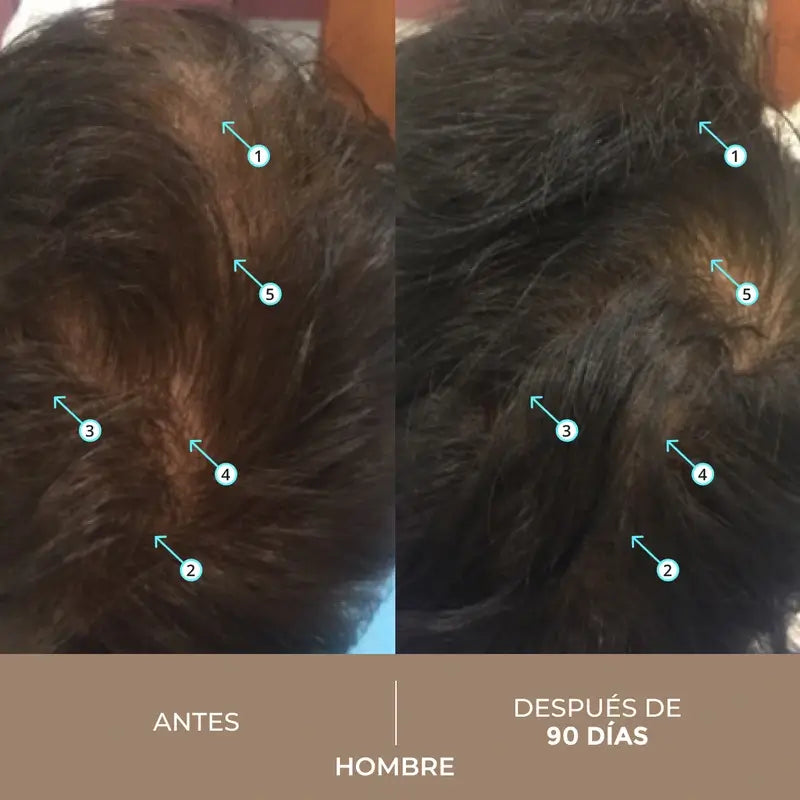 Ds Laboratories Spectral Loción Dnc-N 3 Meses Tratamiento Con Nanoxidil® 5% Contra La Caída Del Cabello, 180 ml