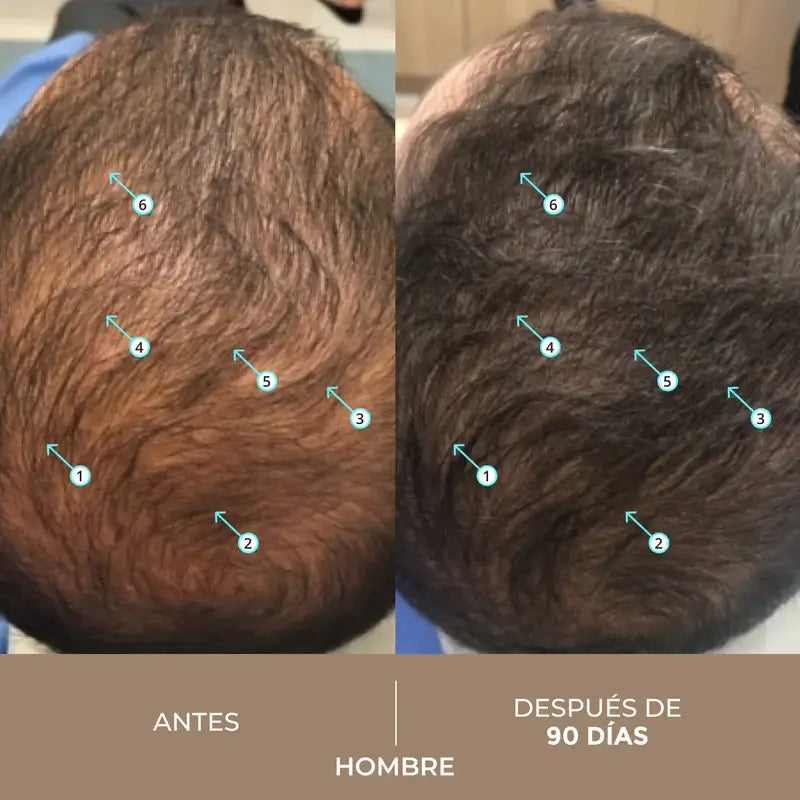 Ds Laboratories Spectral Loción Dnc-N 3 Meses Tratamiento Con Nanoxidil® 5% Contra La Caída Del Cabello, 180 ml