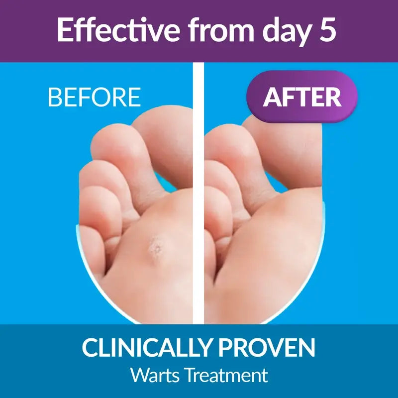 Excilor Pen Tratamiento de la Micosis de las Uñas, 3,3 ml