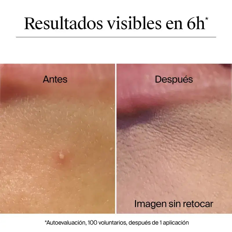 Neutrogena Clear & Defend+ Parches Granos Hidrocoloides Anti Acné 30 Uds