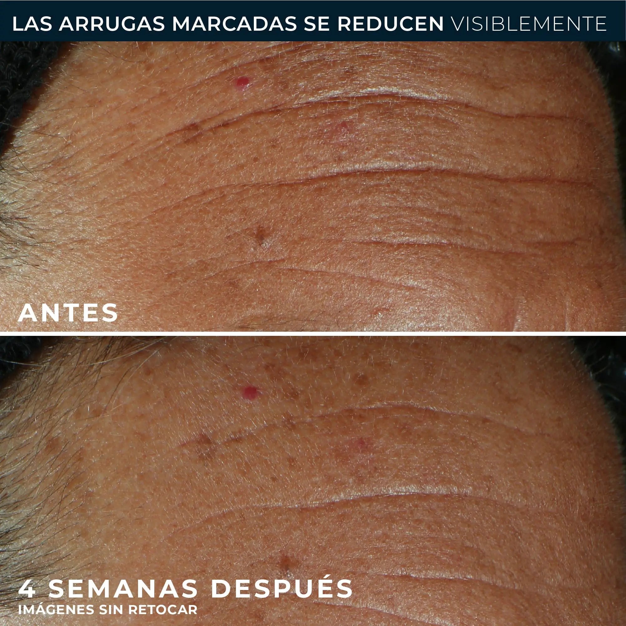 Roc Skincare Iberia Roc® Derm Correxion® Fill + Treat 15Ml